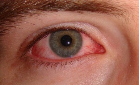 Pink eye ashob chasham viral
