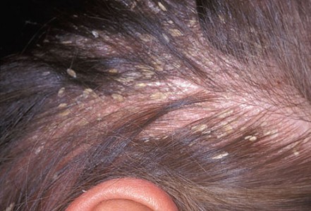 Dandruff and Other Scalp Problems