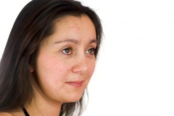 Causes of Adult Acne