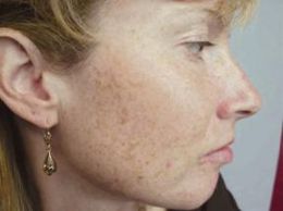 How to Eliminate Black Spots on Face