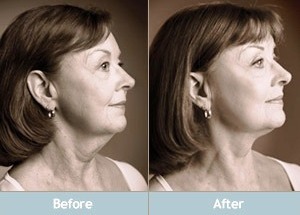 Natural Facelift Tips