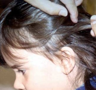 Remedies for Head Lice