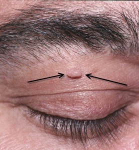 Removing Skin Tags