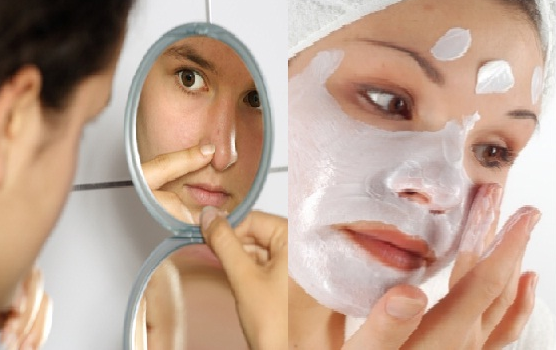 Face masks for acne scars